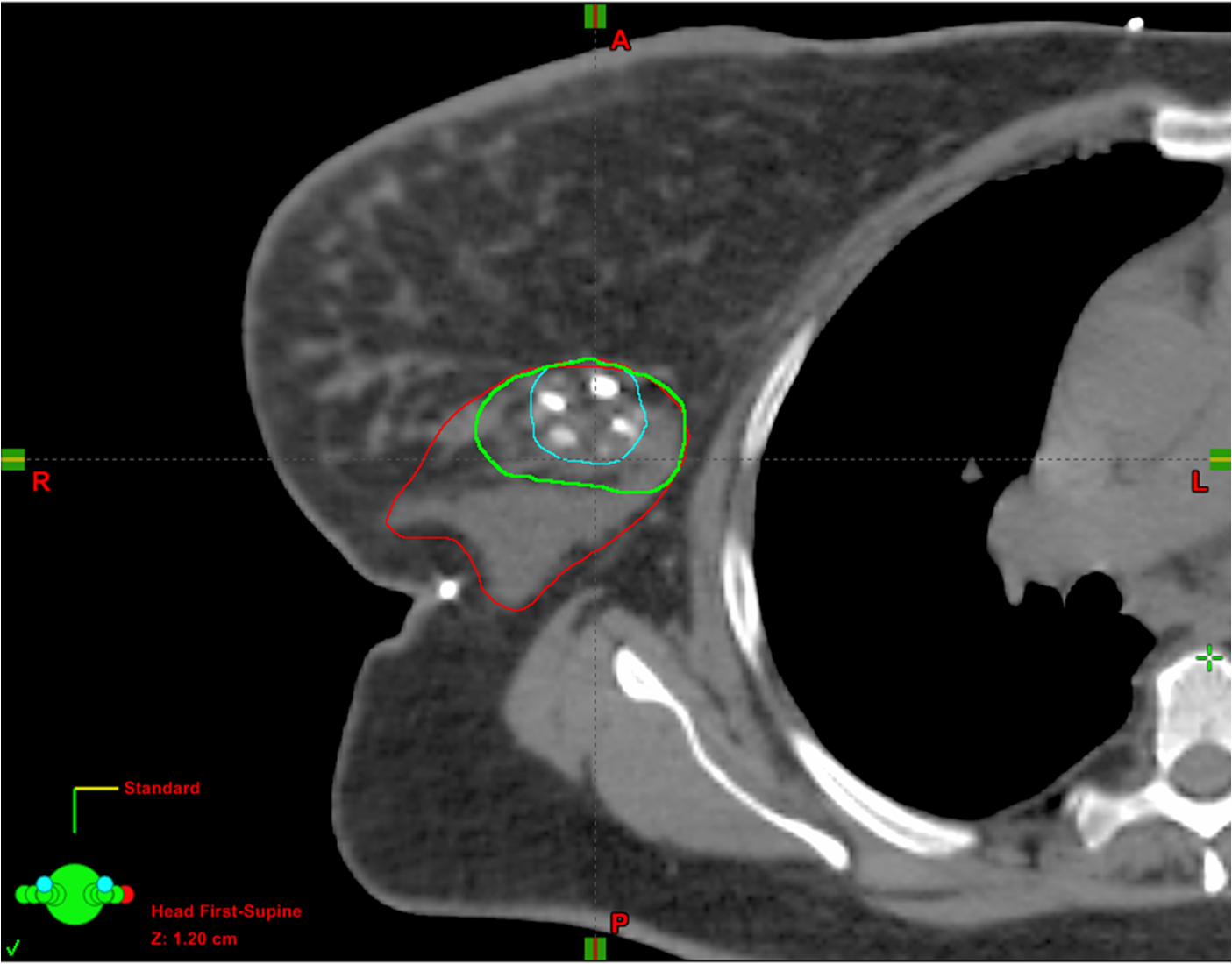 Breast Cancer Radiation Planning Imaging Technology News